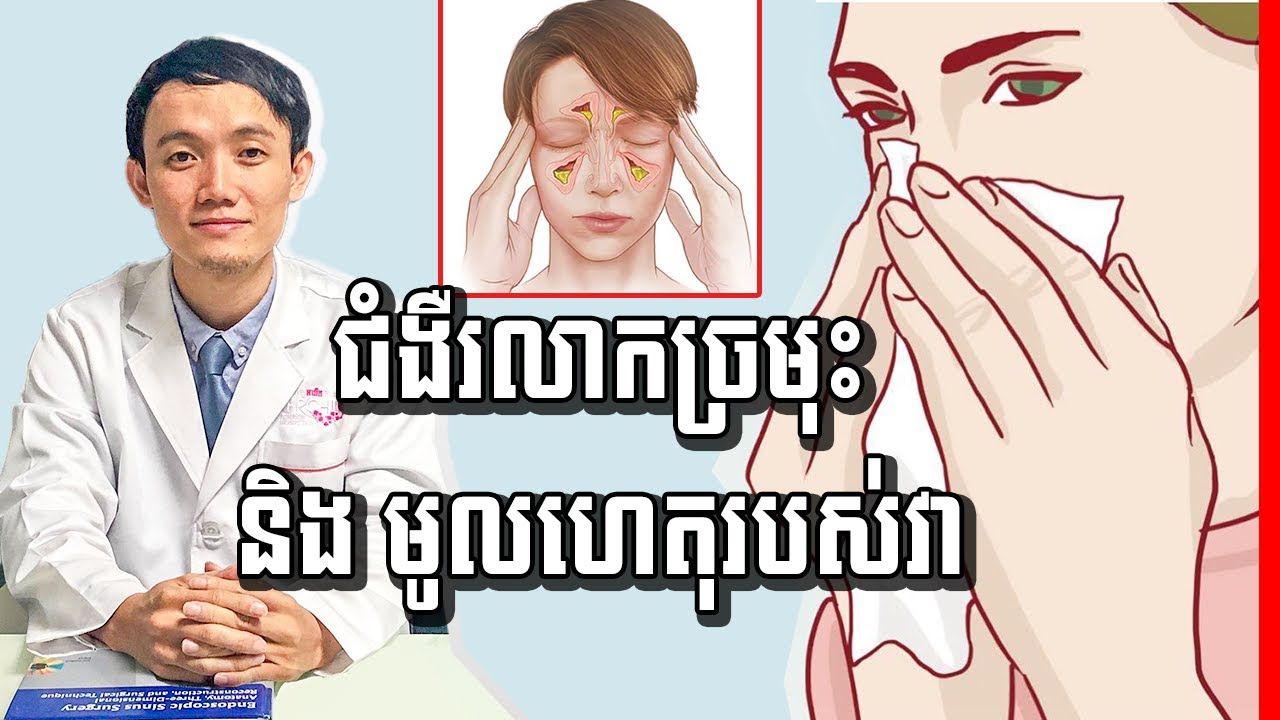 ជំងឺរលាកឆ្អឹងស៊ីនុស មុខ និងអាការៈឈឺក្បាល , Facial sinusitis