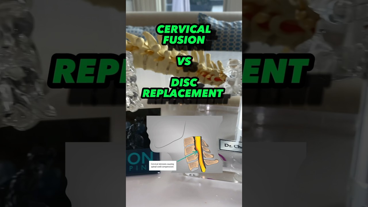 Cervical FUSION vs &ldquo;REPLACEMENT&rdquo; - both are honestly GREAT for the right INDICATORS ✌️🏅