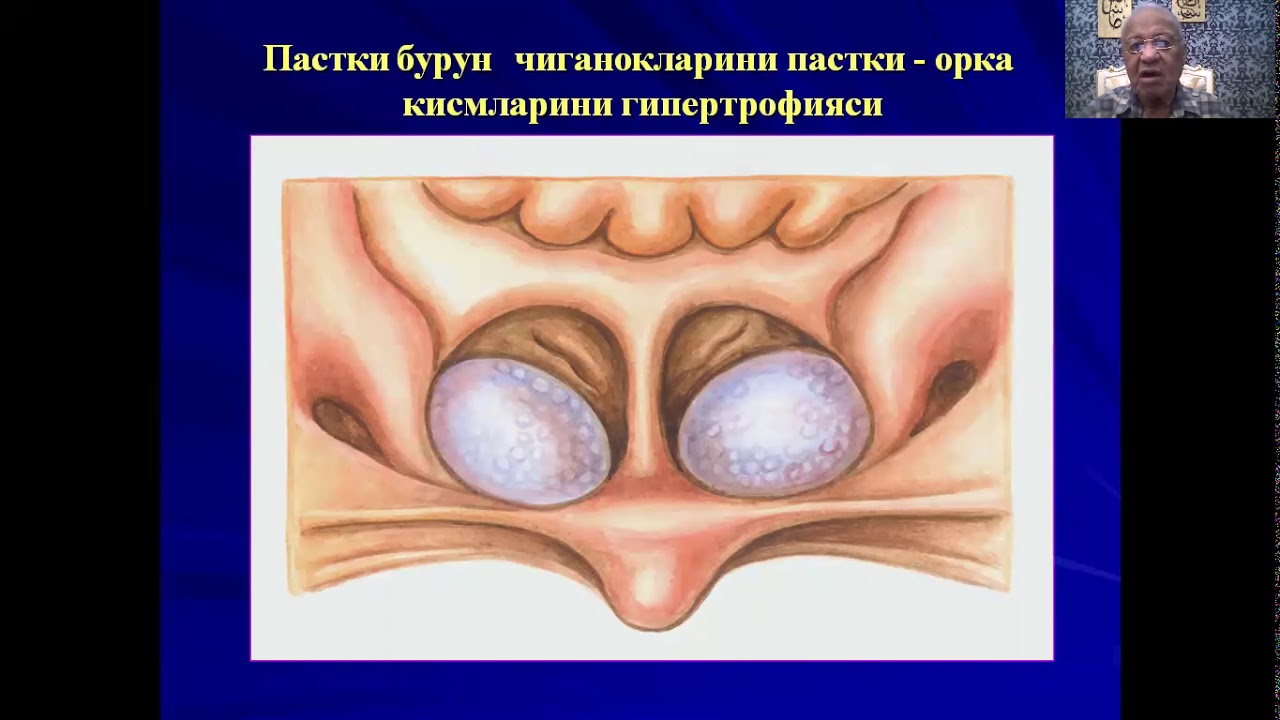 Ўткир ва сурункали ринит