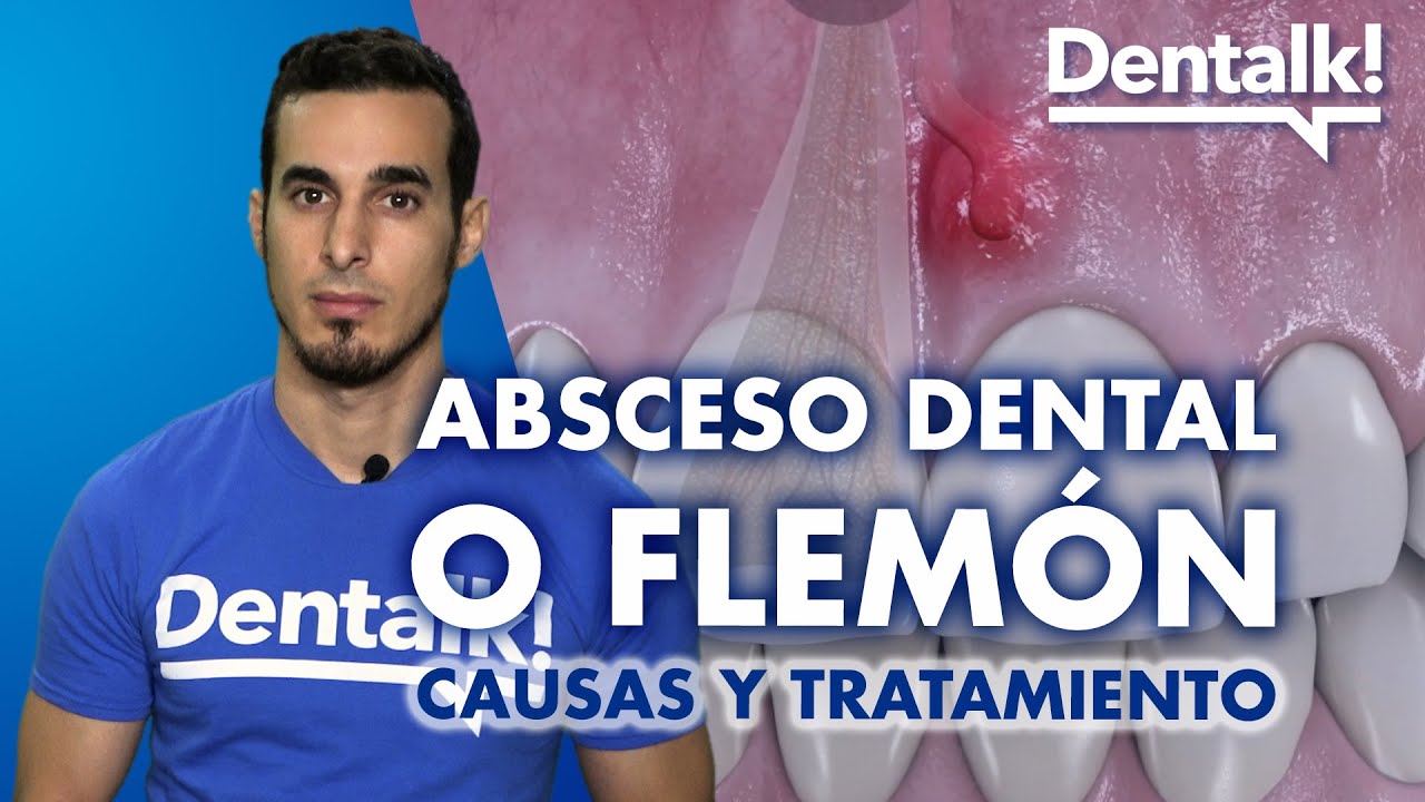 C&oacute;mo curar un FLEM&Oacute;N - Causas, tratamiento y remedios caseros del ABSCESO dental | Dentalk! &copy;