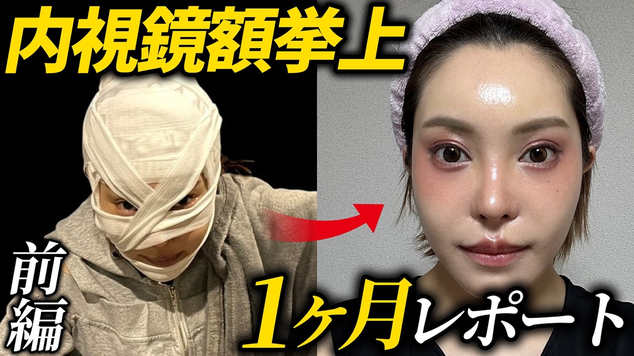 【前額リフト】「今までで一番満足度高い」内視鏡額挙上で柔らかい目元へ【前編】