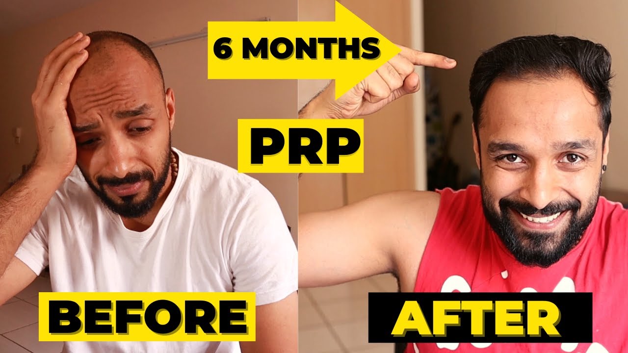 ✅ PRP 6 MONTH RESULTS - 3 PRP sessions | HAIR TRANSPLANT vs PRP which one should you really go for?