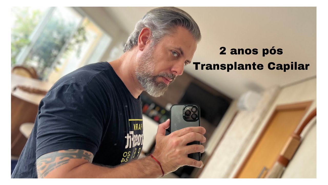 Meu Transplante Capilar - 2 anos de transplante capilar FUE. 6157 folículos - medicações e cuidados!