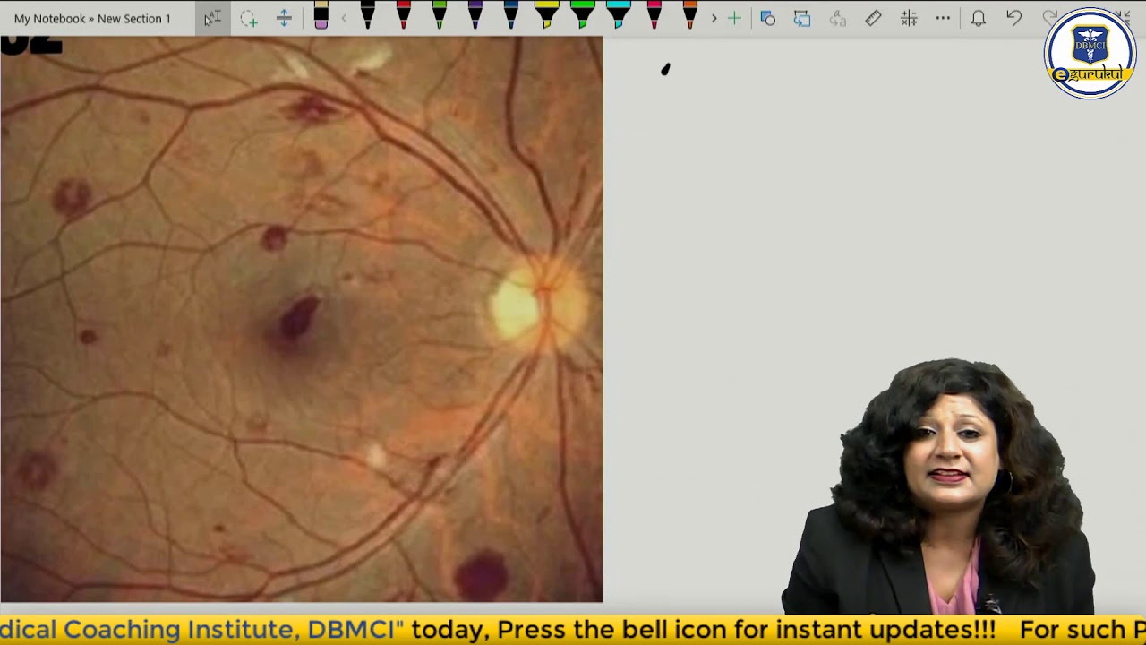 Ophthalmology Rewind | Fundus Pathologies |NEET PG Preparation