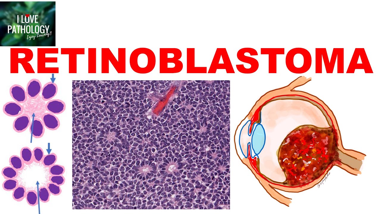RETINOBLASTOMA: Etiopathogenesis, Types, Clinical features Morphology & treatment