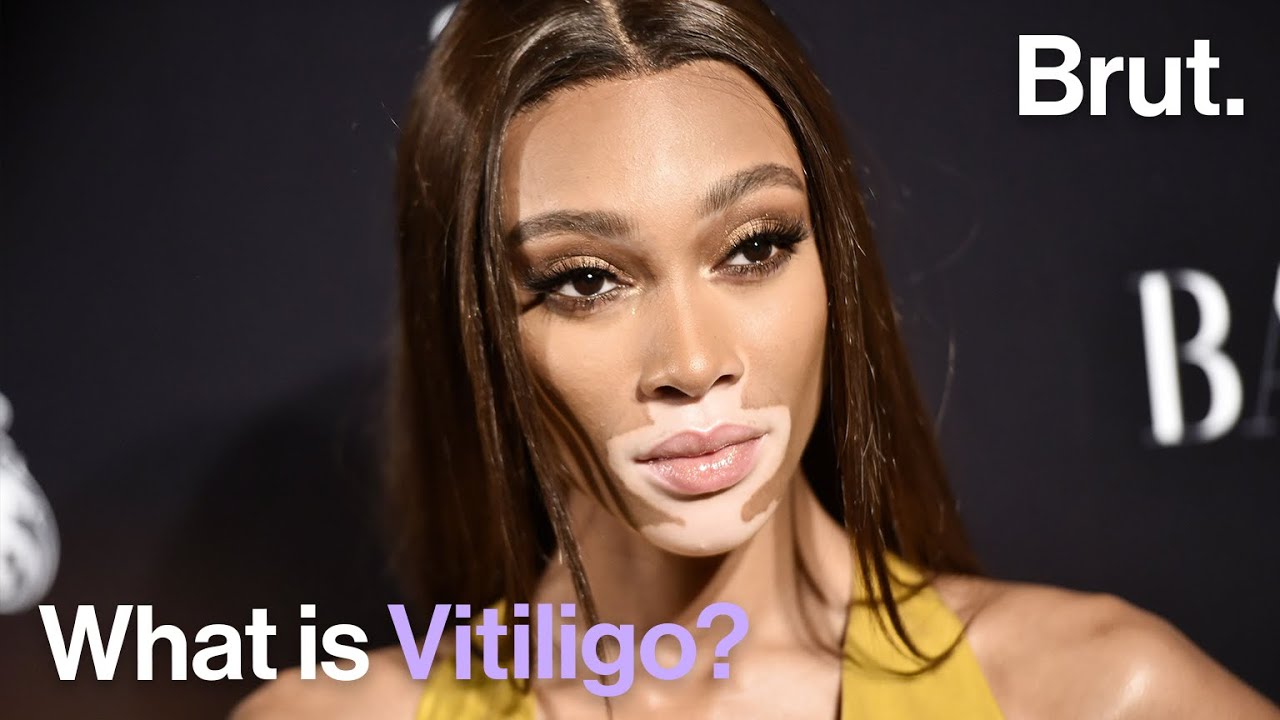 What is Vitiligo?