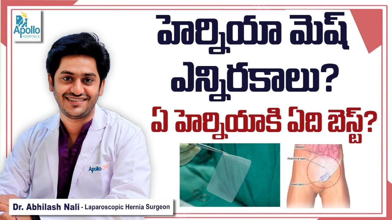 హెర్నియాకి ఏ మెష్ బెస్ట్? || What is the Best Mesh for Hernia Surgery? || Dr Abhilash Nali
