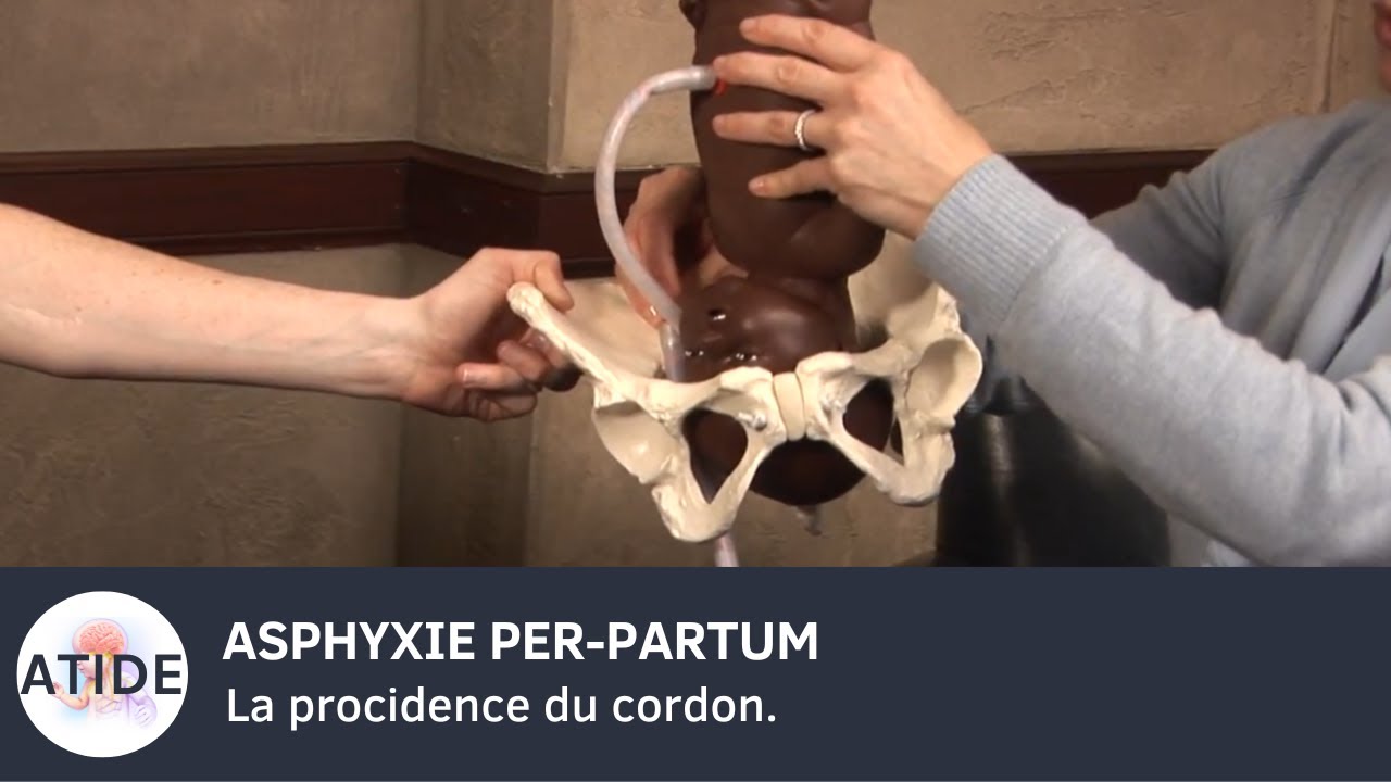 La procidence du cordon.