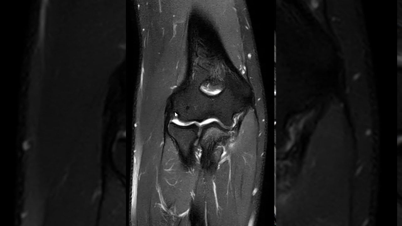 Ulnar collateral ligament (UCL) tear and cortical avulsion from the sublime tubercle