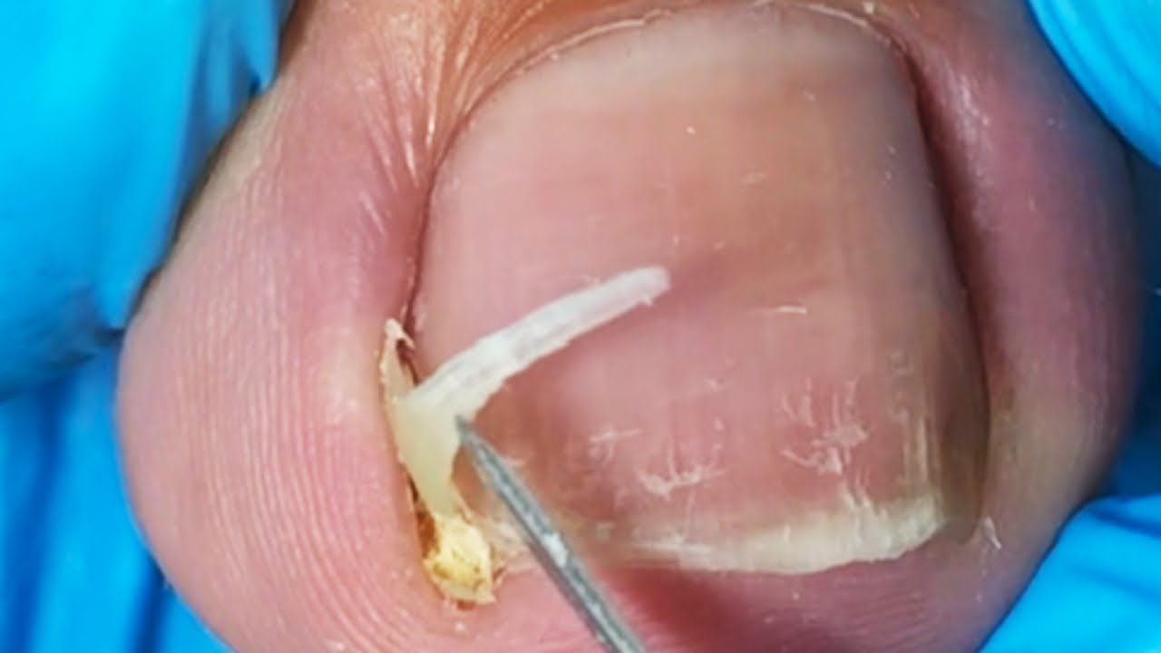A Lot Of Dead Skin Accumulates Under The Ingrown Toenails; Regular Trimming Is Necessary
