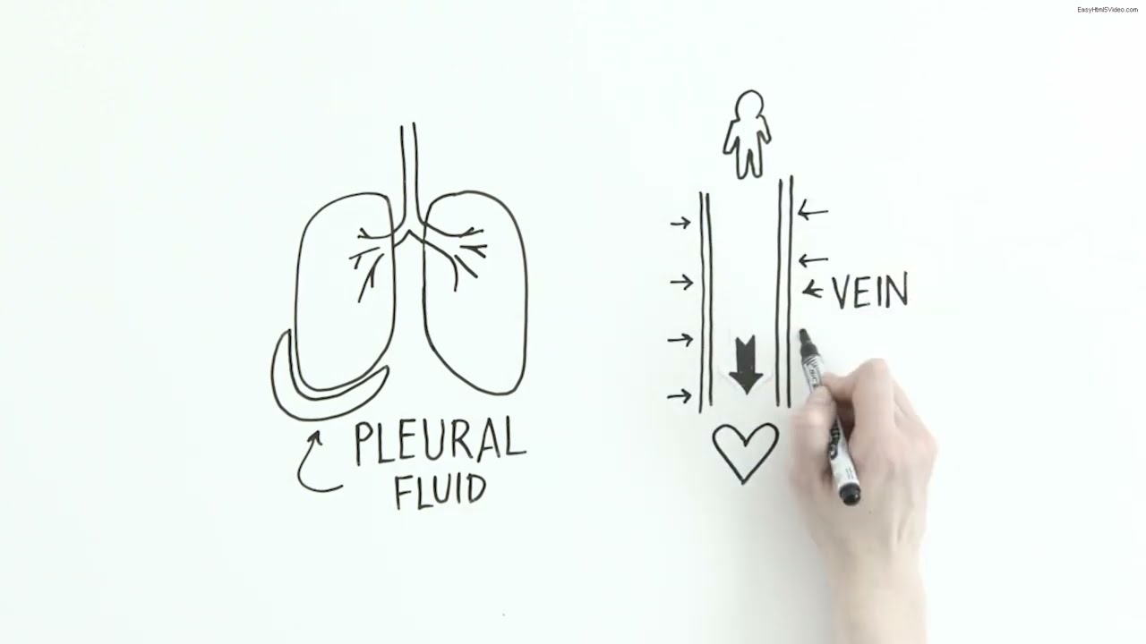 Chest Drains after the Fontan Procedure