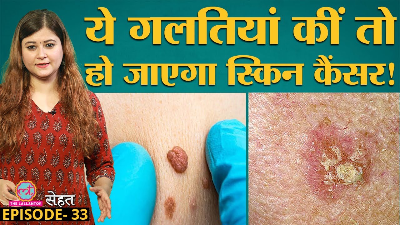 जानिए क्यों हो जाता है Skin Cancer और उससे बचने के उपाय Doctors से | Sehat Ep 33