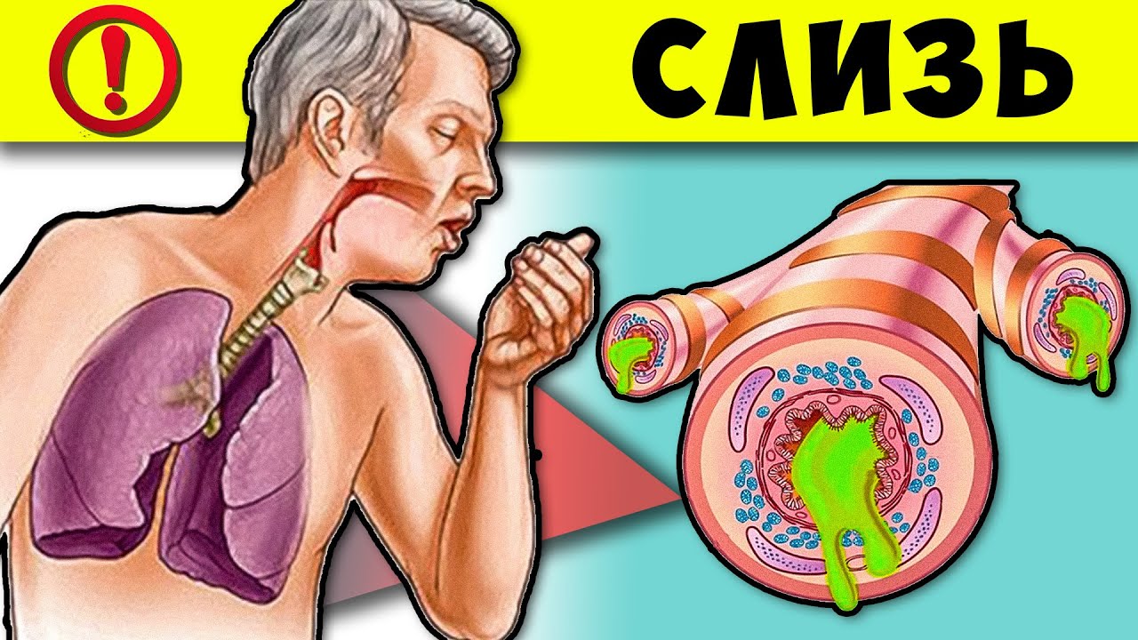 Моментально рассосёт Слизь и Мокроту! Простые методы спасут Бронхи и Горло...
