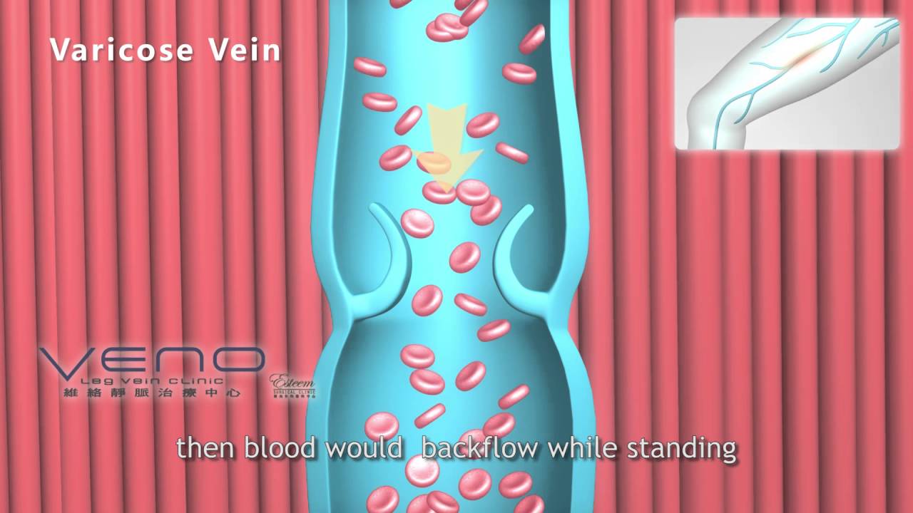 Varicose veins, varicose veins symptoms - Veno, leg Vein Clinic, hong kong