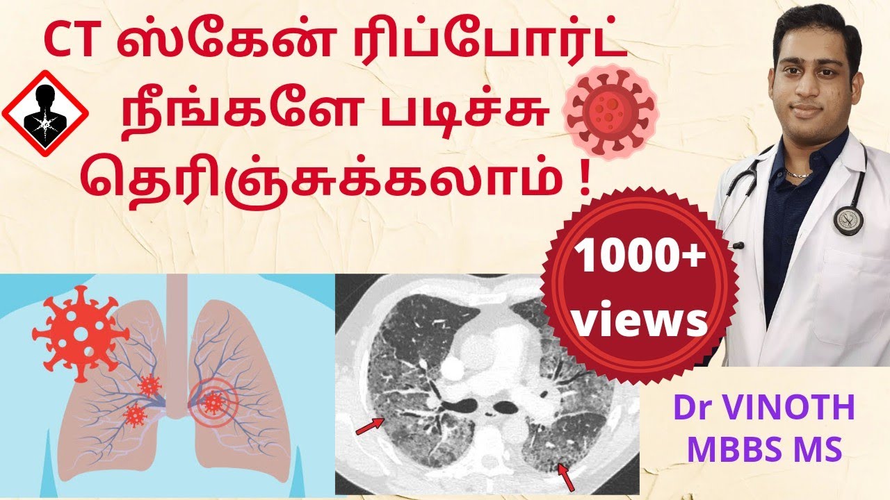 CT scan in Covid19 tamil | CT score tamil | CORADS tamil | Dangers of CT | What to see in reports