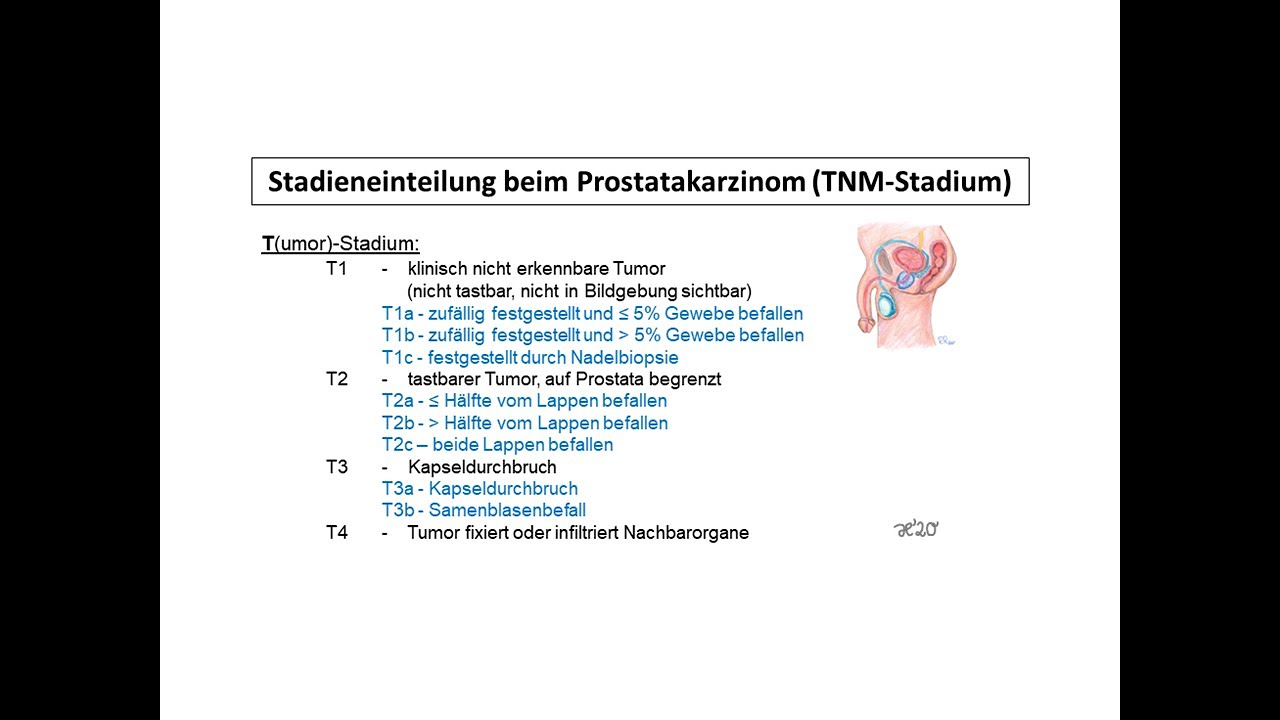 Stadieneinteilung beim Prostatakarzinom (TNM-Stadium) | Strahlentherapie Prof. Hilke Vorwerk