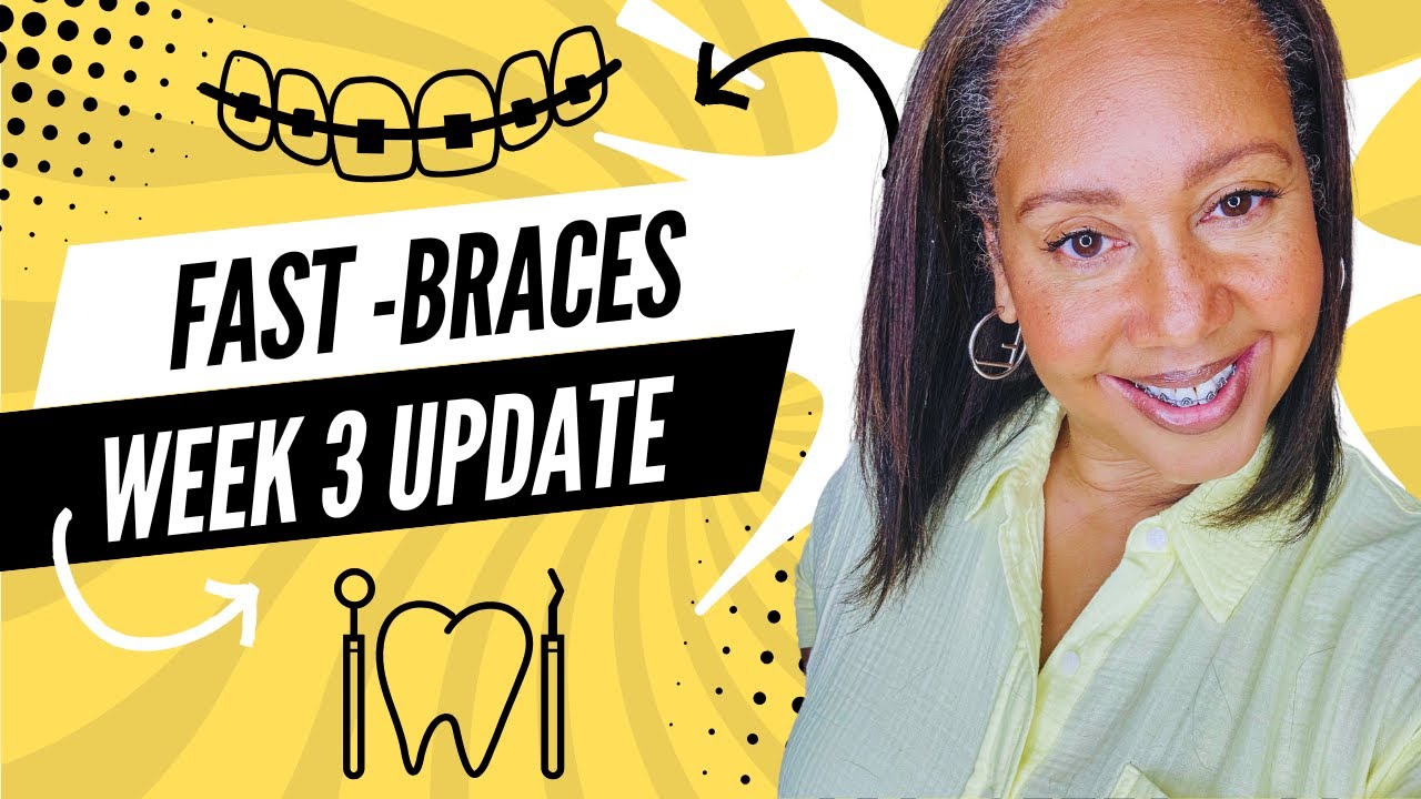 "Fast-Braces Update: Quick Results, Real Discomfort | How do they feel? – Week 3 Journey"