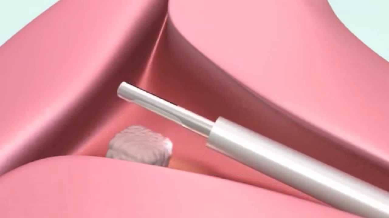 How MyoSure is a Minimally Invasive Method to Remove Uterine Fibroids and Polyps