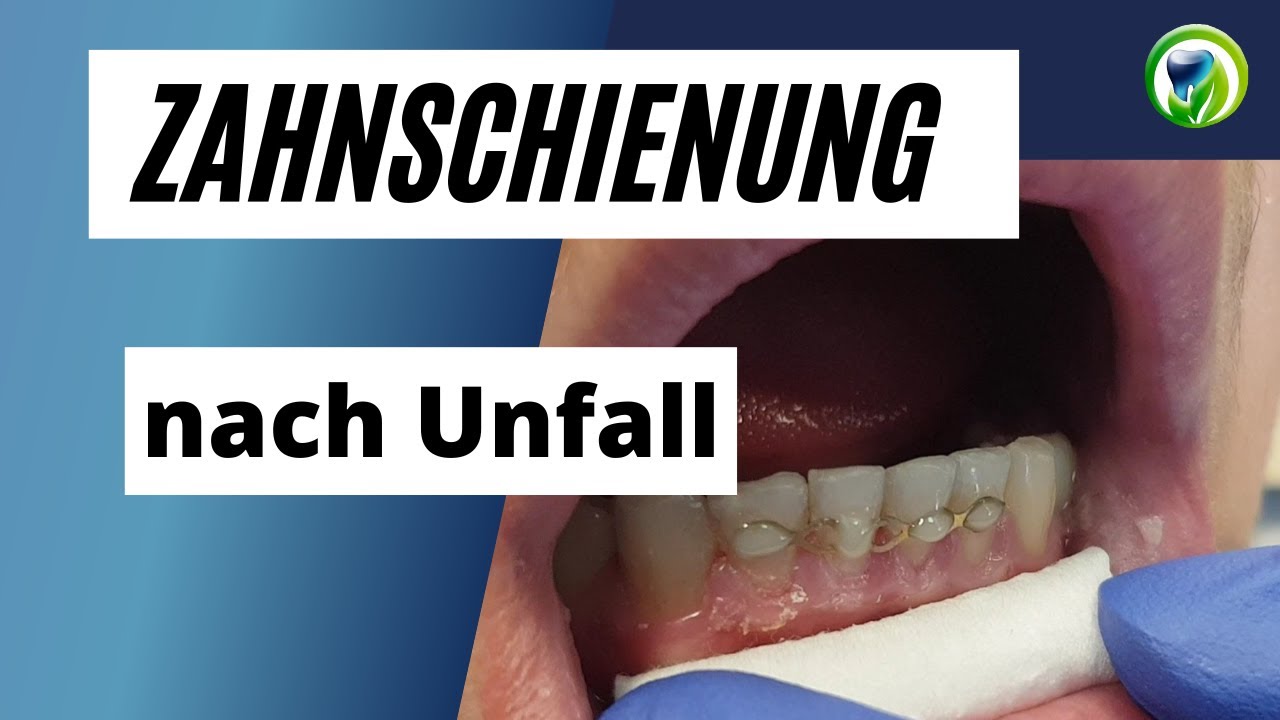 Schienung nach Zahnunfall - Zähnen locker, was tun?