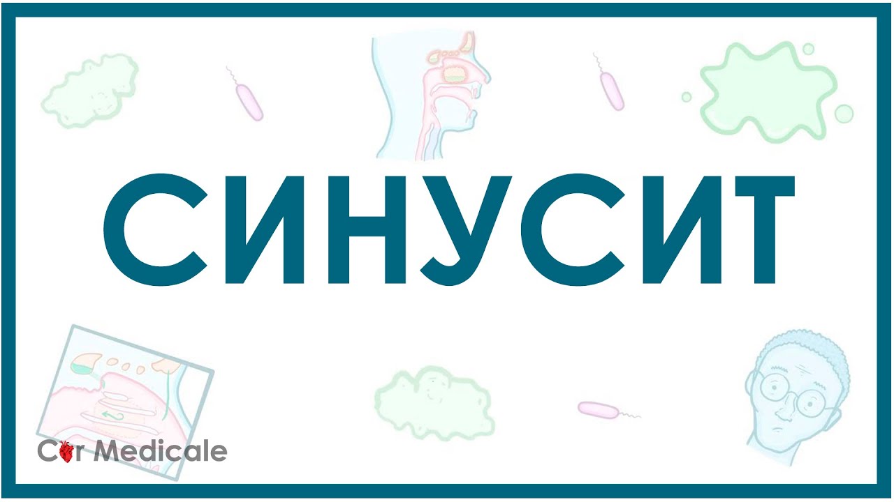 Синусит: механизм развития, симптомы, диагностика, лечение - кратко