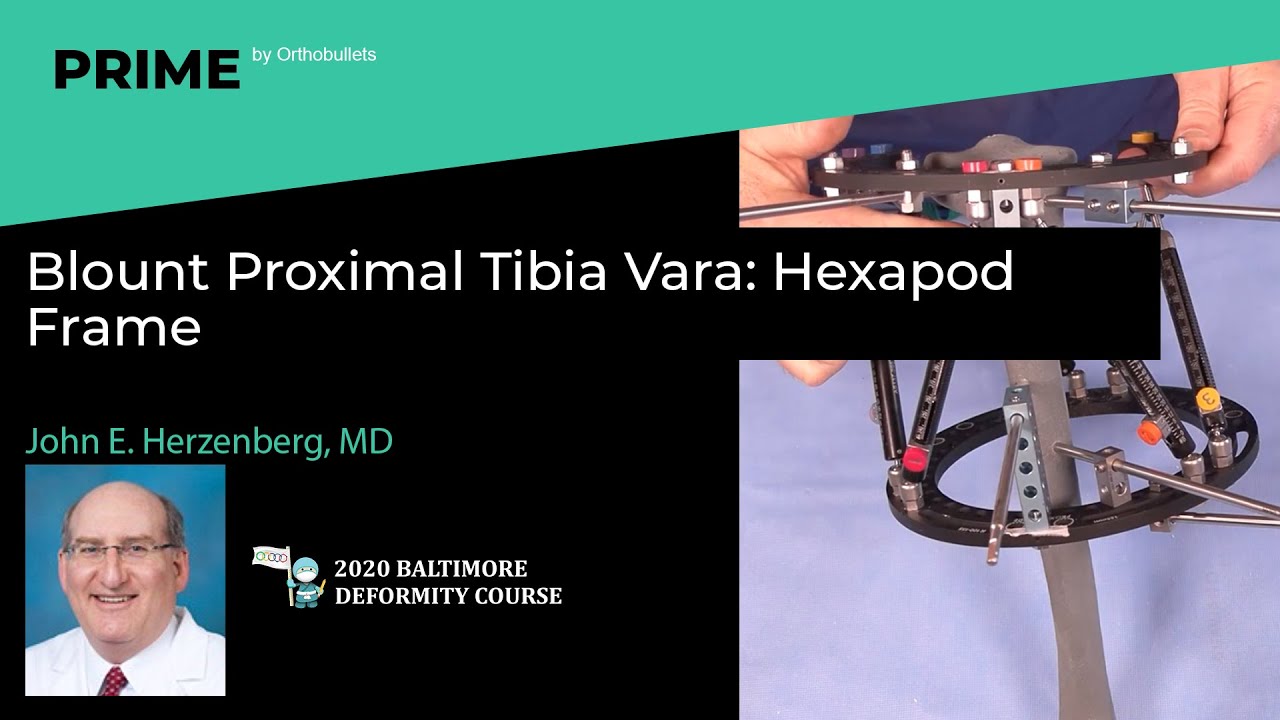Blount Proximal Tibia Vara: Hexapod Frame - John E. Herzenberg, MD