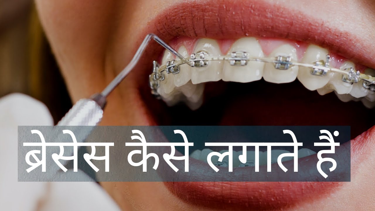 30 min  ब्रेसेस कैसे लगाते हैं, How To put on #Dental Braces Step by Step process in Delhi