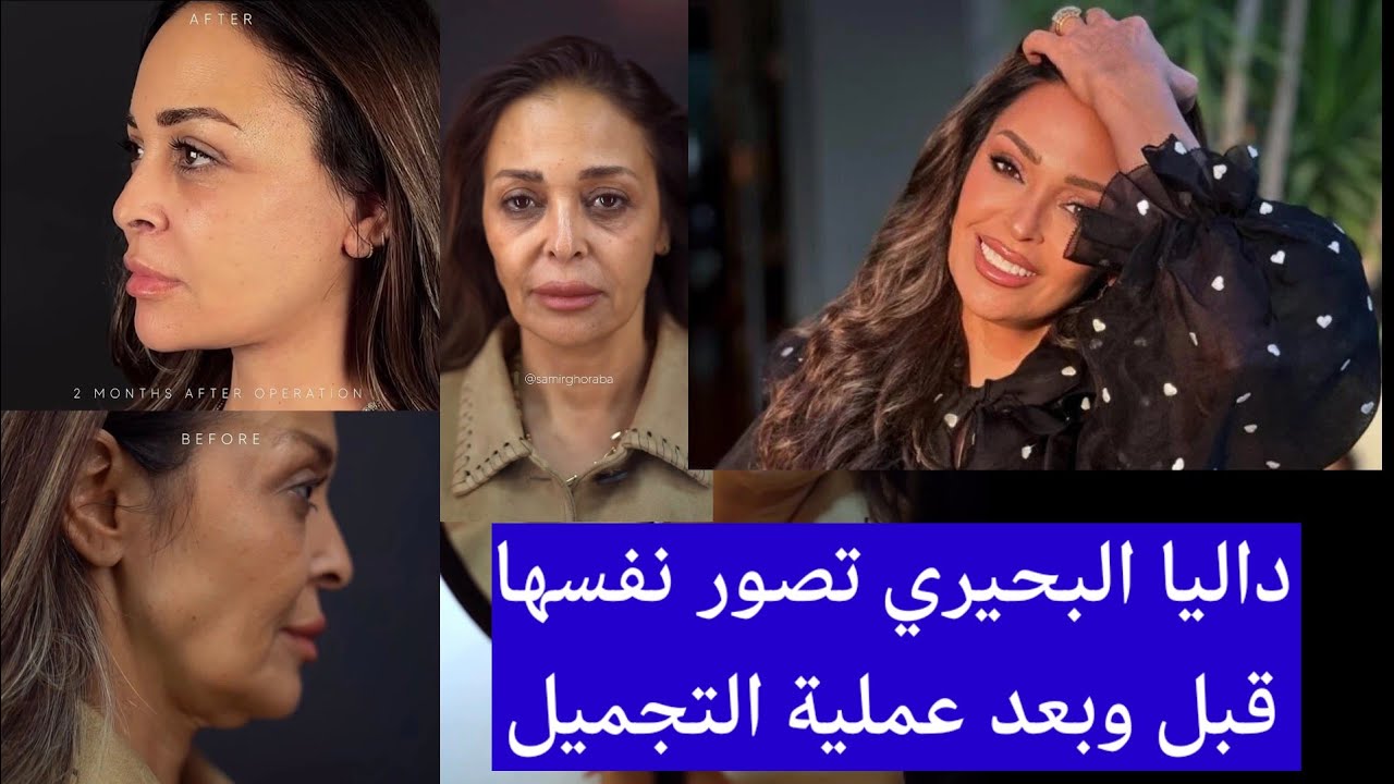 شاهد داليا البحيري قبل وبعد عملية التجميل صغرت 20 سنة والجمهور يعلق على  جرأتها