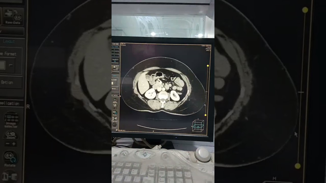 Chest , Abdomen and Pelvis with Contrast for CA Brest 