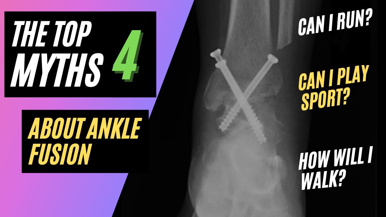 What Can I Do After an Ankle Fusion: 4 Myths About Ankle Fusion