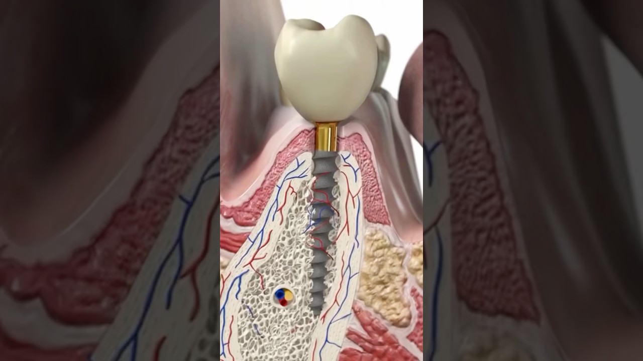 👨‍⚕️Դիմածնոտային վիրաբույժ Կարեն Վարդանյան 📲055-35-75-53 #իմպլանտացիա #իմպլանտ #հետաքրքիր