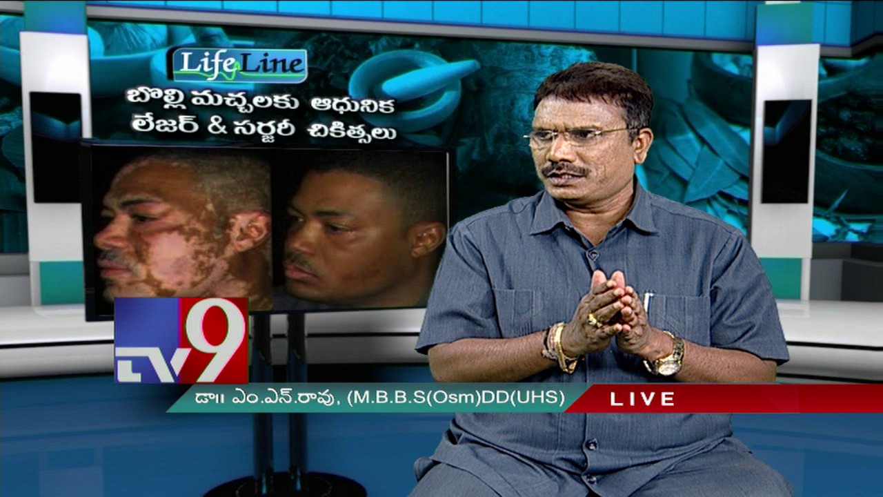 Vitiligo - Lates and Laser and surgery treatment - Life Line - TV9