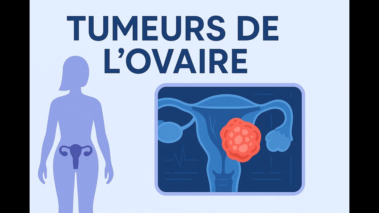 Tumeurs de l’Ovaire : Types, Diagnostic et Prise en Charge