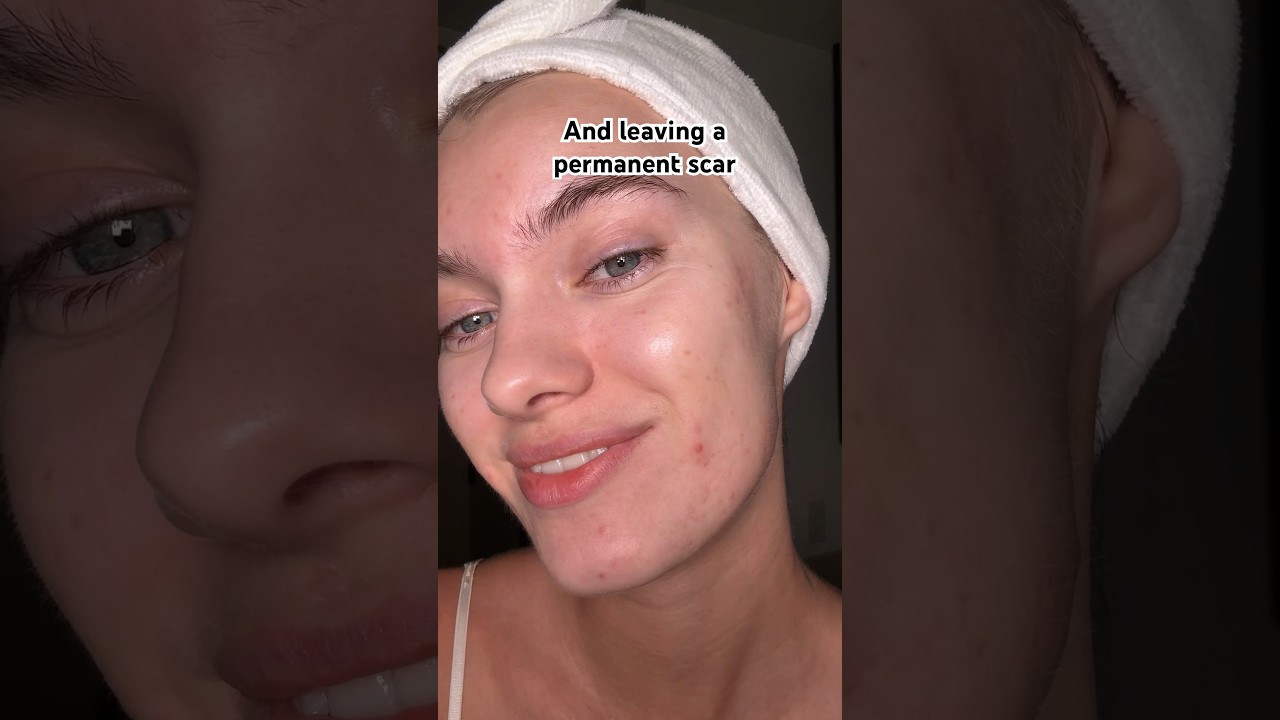 Rule of popping pimples without scarring🫶🏻💖 it will reduce the potential damage✨ #acne #pimple