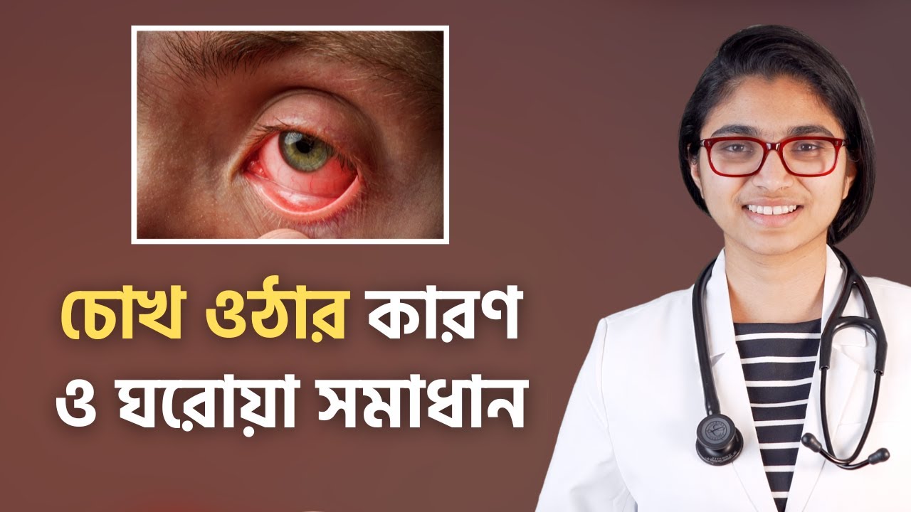 চোখ ওঠার কারণ ও ঘরোয়া সমাধান — ডা. তাসনিম জারা (চিকিৎসক, ইংল্যান্ড)