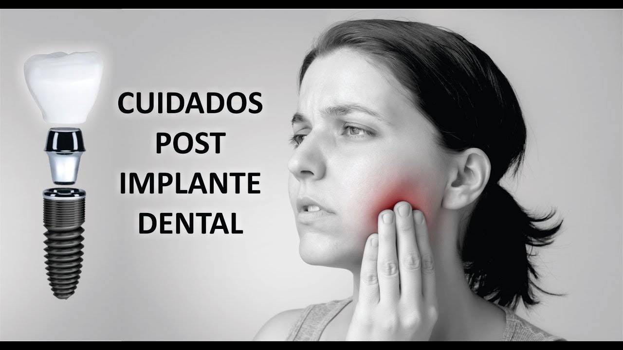 QUÉ CUIDADOS DEBES TENER LUEGO DE COLOCARTE UN IMPLANTE DENTAL