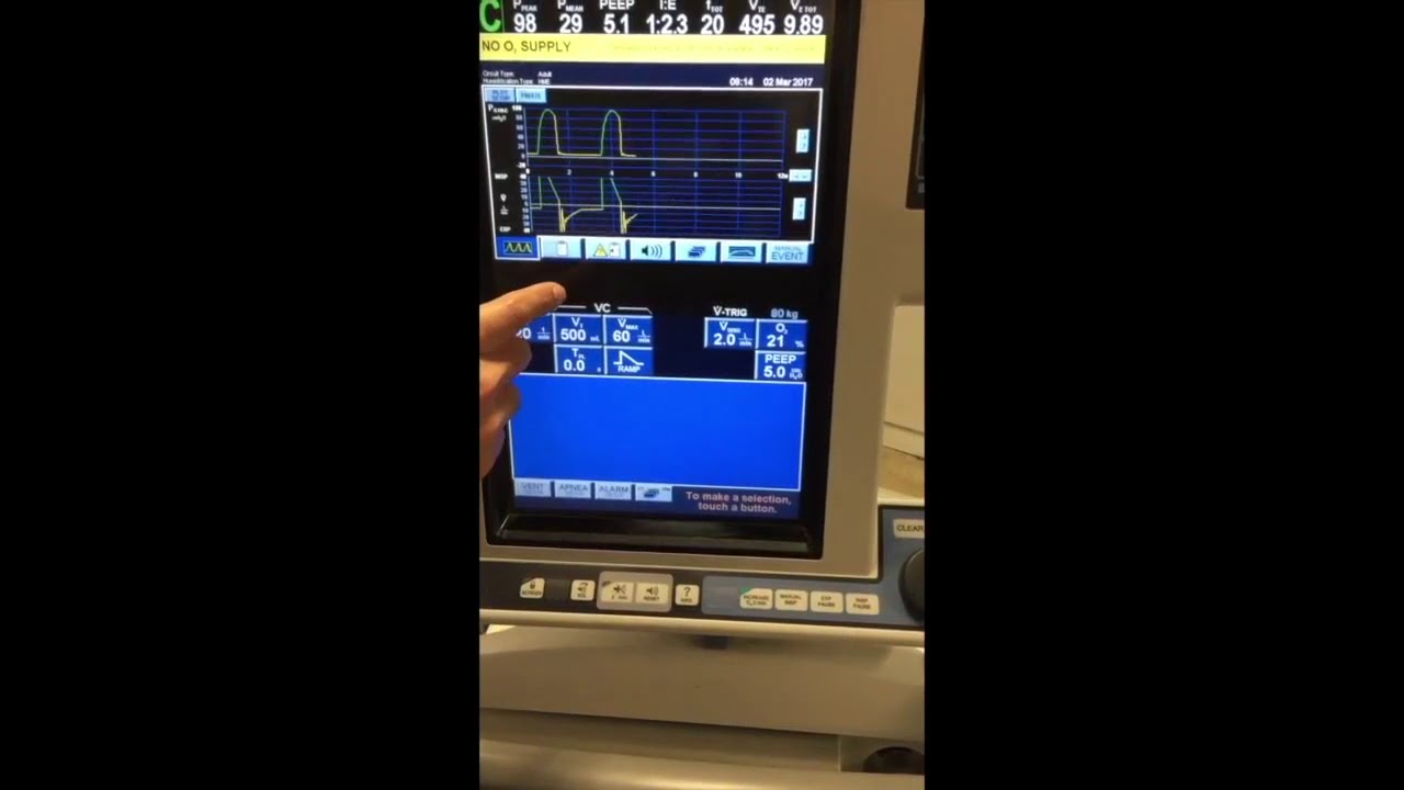 Identifying and Treating AutoPEEP