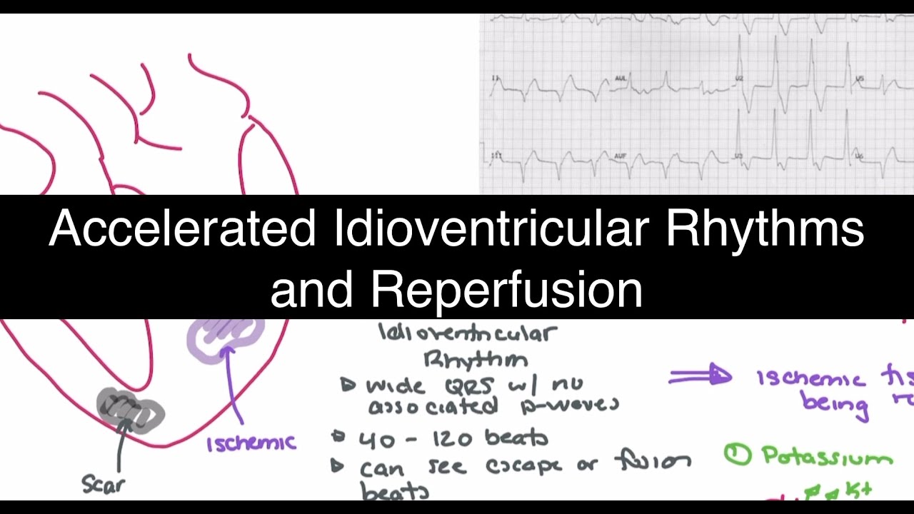 Accelerated Idioventricular Rhythms and Reperfusion