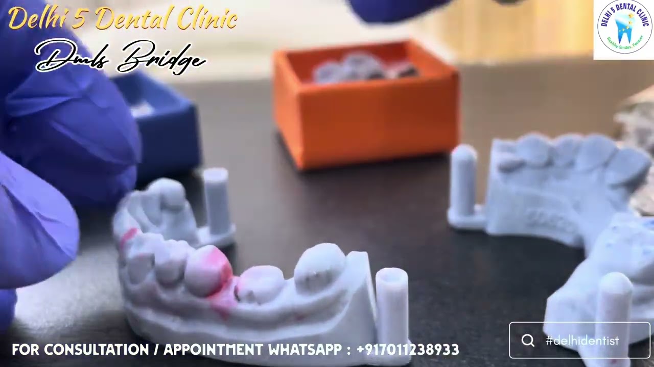 🚨Unboxing Premium DMLS Crown with 7 Year Warranty! 💯 | Delhi 5 Dental Clinic ​⁠| @BeingDental