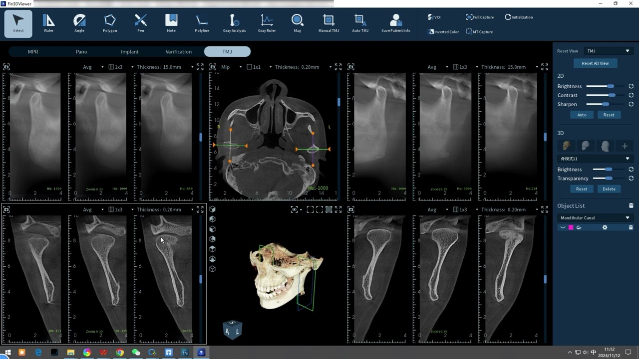 FinScan F350 Temporomandibular Joint-Search and Localization of the Condylar Process