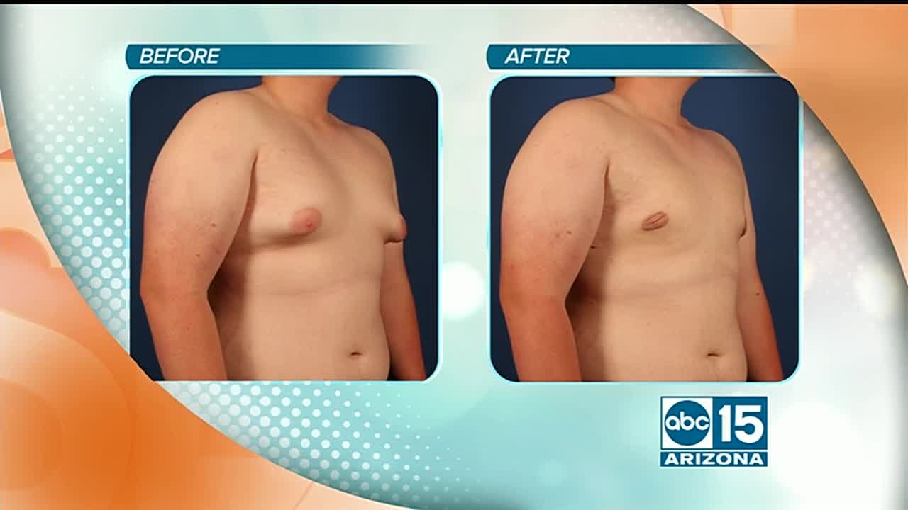 Natural Results offers surgical Gynecomastia augmentation