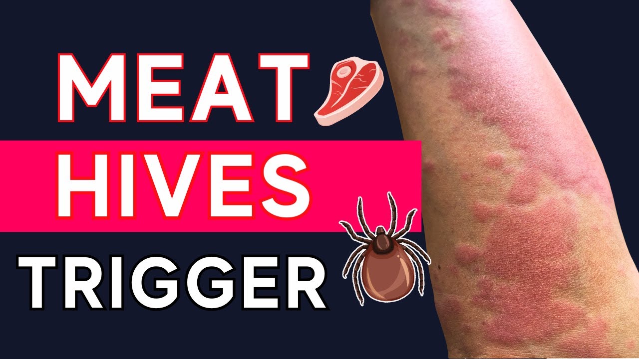 NEW Meat Allergy Symptoms From Tick Bite TRIGGER Hives + Itch | Dr. David Fitzhugh