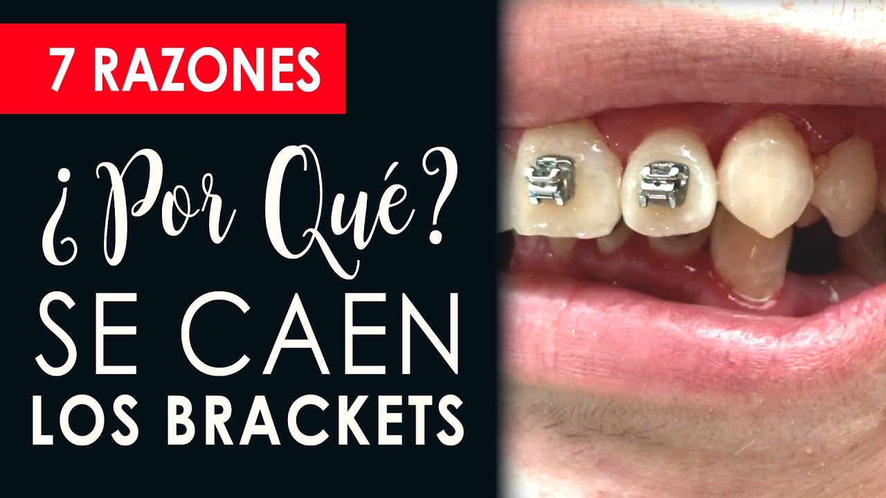 ¿Por qué se caen los brackets? | 7 RAZONES