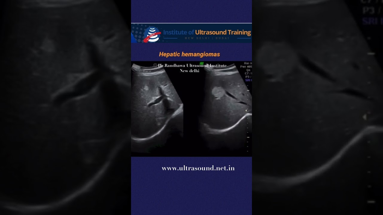 #hemangioma #liver #ultrasound #drrandhawainstitute #ultrasoundvideos #ultrasoundcases