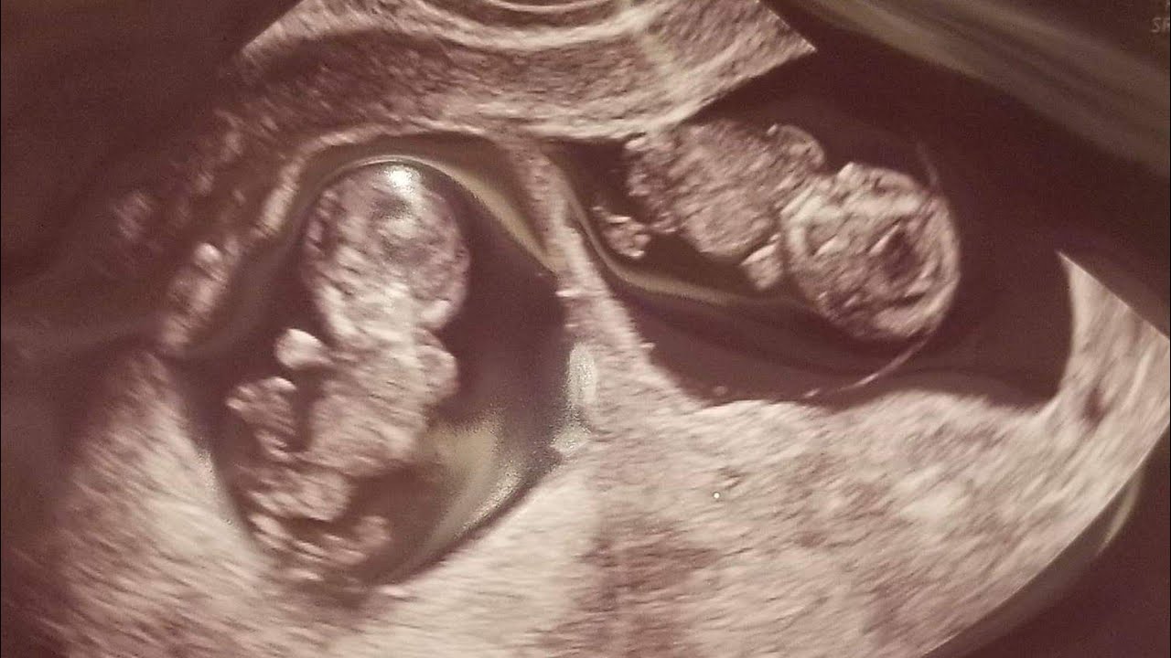 Nine Week Twin Ultrasound | Twin Pregnancy