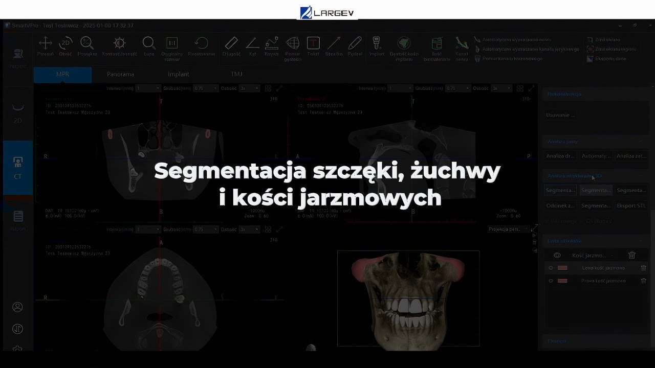 Tomograf stomatologiczny Smart3D-X - Segmentacja żuchwy, szczęki i kości jarzmowych