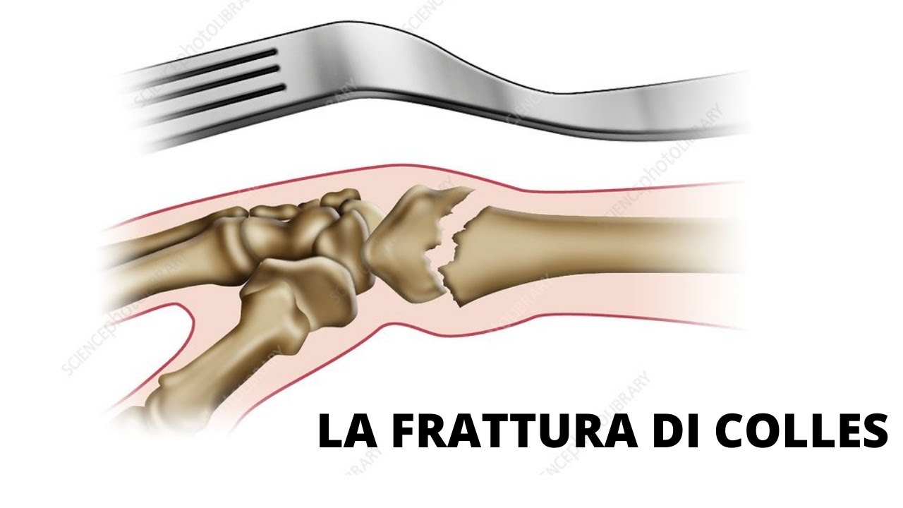 Il percorso riabilitativo nella frattura di Colles