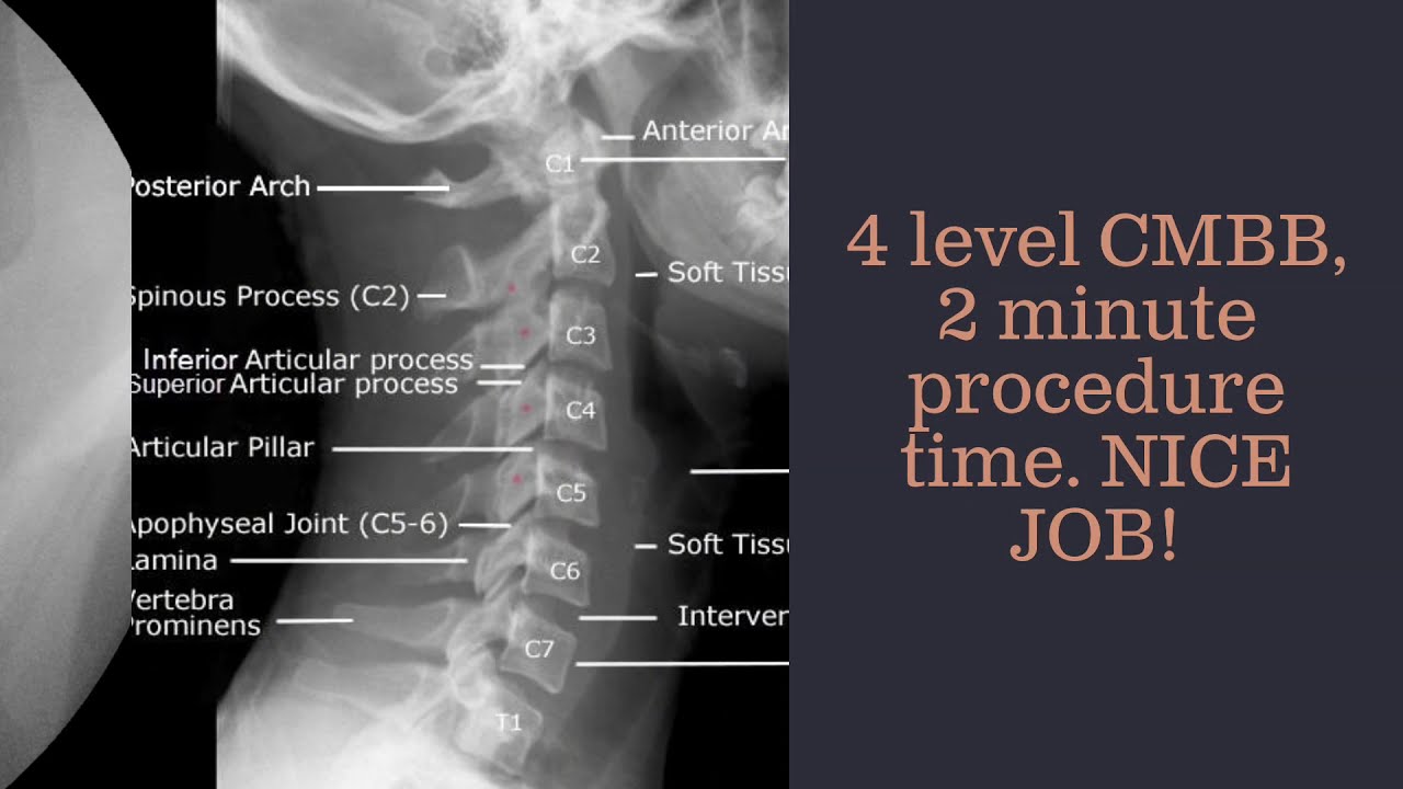 2 Minute Cervical Medial Branch Block