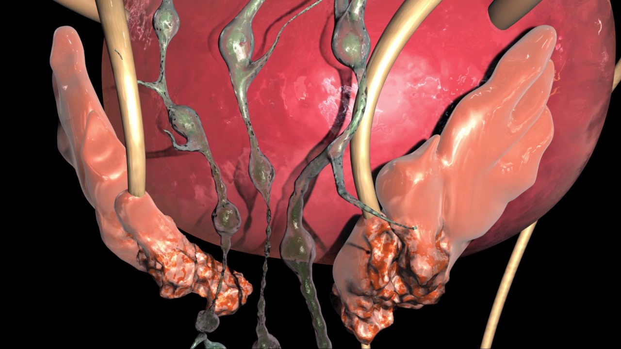 Learn about prostate removal