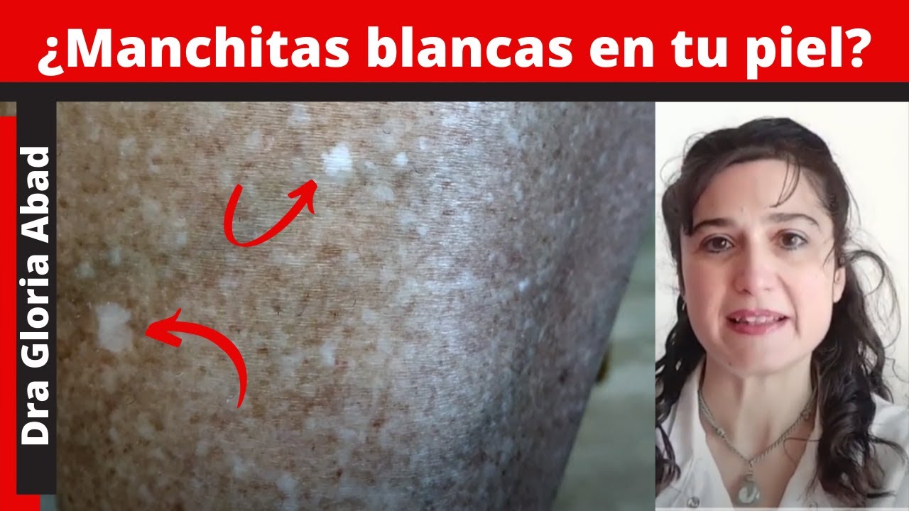 ¿MANCHITAS BLANCAS en la piel? ( ATROFIA SOLAR lenticular)🌞