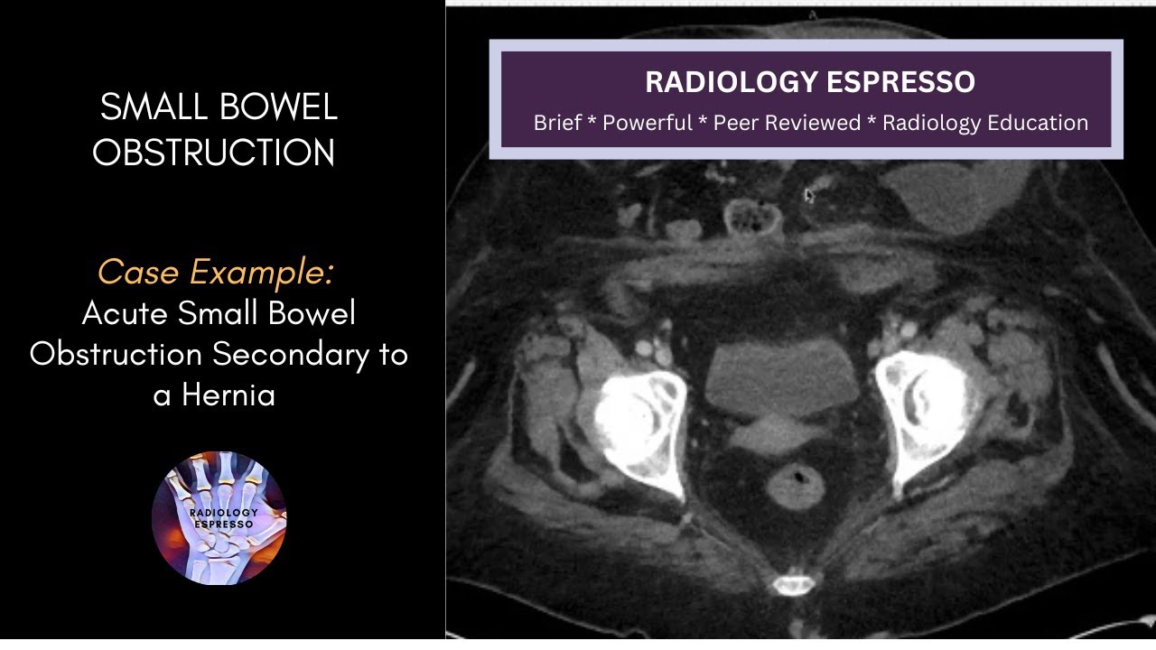 SMALL BOWEL OBSTRUCTION: Case Example – Acute Small Bowel Obstruction Secondary to a Hernia (4250)